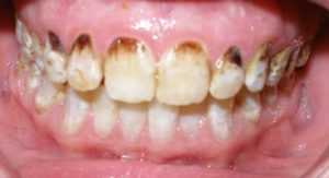 Fluoride in San Antonio