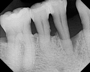 Dental X-Rays in San Antonio
