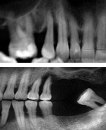 Gum Disease in San Antonio