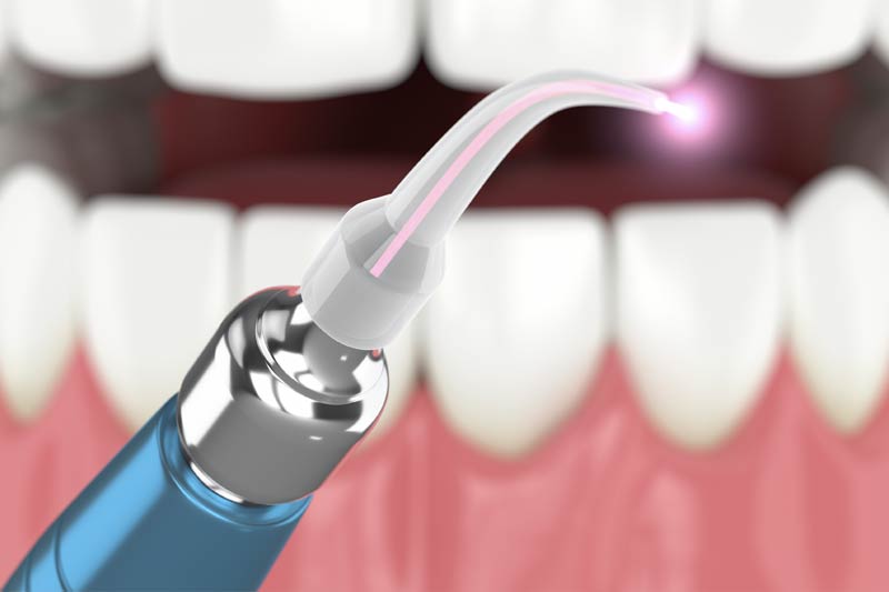 Periolase® in San Antonio