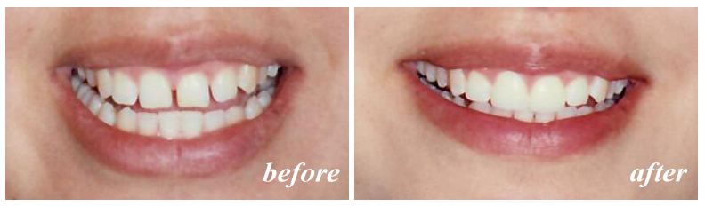 Cosmetic dentistry can makeover your smile with porcelain veneers.