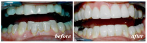 Cosmetic dentistry can makeover your smile with porcelain veneers.